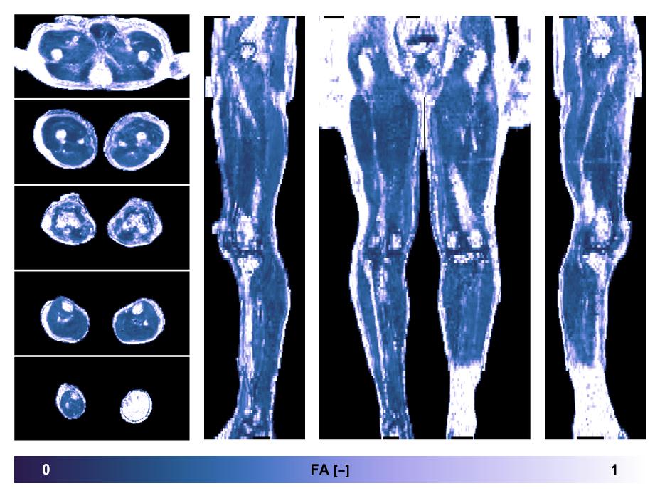 IVIM corrected whole leg muscle fractional anisotropy obtained from diffusion tensor imaging.